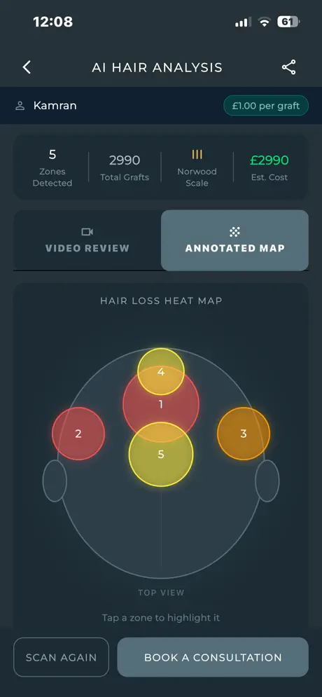 SurgiTracker Hair & Scalp AI hair loss heat map and graft estimate